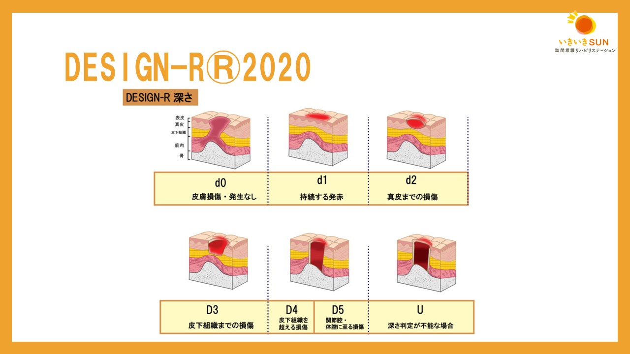 Design R Tool 褥瘡 深さ Du _ 褥瘡 Du と Dti の違い : 最新情報を知っておこう!褥瘡評価 DESIGN-R®2020とは? – LDOK